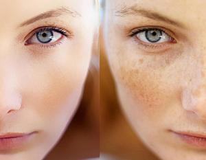 Фотоомоложение, что это такое?